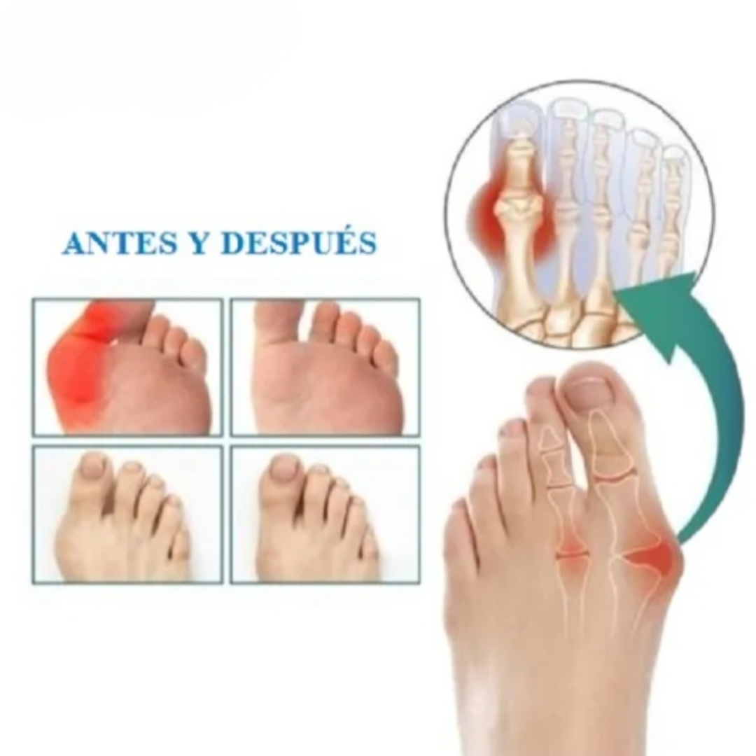 BunionRelief™ – Parche Corrector Invisible